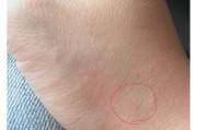 被狗咬，是否需要打狂犬疫苗？（了解被狗咬伤后打狂犬疫苗的必要性及时限）